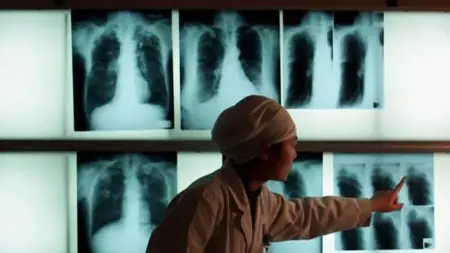 مذكرة توقيف بحق أميركية رفضت علاجها من مرض السل مذكرة توقيف بحق أميركية رفضت علاجها من مرض السل