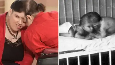 وفاة أكبر توأم ملتصق في العالم وفاة أكبر توأم ملتصق في العالم