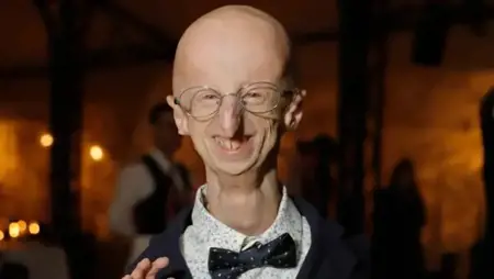 إيطاليا.. وفاة المصاب بالشيخوخة المبكرة الأطول عمرا إيطاليا.. وفاة المصاب بالشيخوخة المبكرة الأطول عمرا