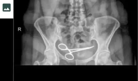 سيدة تركية تكتشف وجود مقص في بطنها بعد 8 أشهر من إجراء عملية جراحية سيدة تركية تكتشف وجود مقص في بطنها بعد 8 أشهر من إجراء عملية جراحية