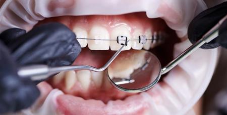 اكتشاف روسي طبي: تأثيرا "غريبا" لتقويم الأسنان على الدماغ