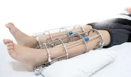 وفاة مواطن سعودي عقب خضوعه لعملية إطالة القامة في اسطنبول وفاة مواطن سعودي عقب خضوعه لعملية إطالة القامة في اسطنبول