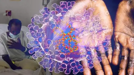 حالة طوارئ صحية عالمية بسبب "جدري القردة" حالة طوارئ صحية عالمية بسبب "جدري القردة"