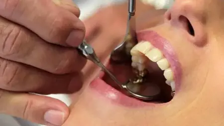 إعلان نتائج DUS 2. تعيينات طب الأسنان المتخصصين الآن متاحة